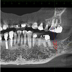 抜歯同時GBR法後のレントゲン
