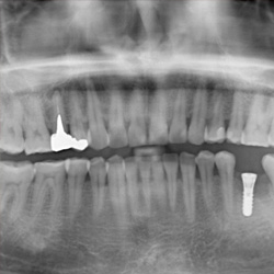 インプラント埋入直後レントゲン写真
