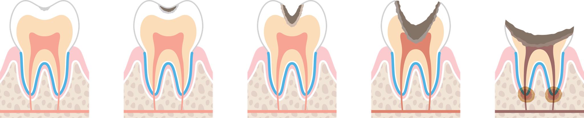 進行した虫歯の治療